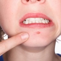 boils on skin - homeopathic treatment for boils