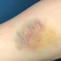 Bruise